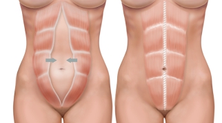 A abdominoplastia e a nova plicatura do reto abdominal